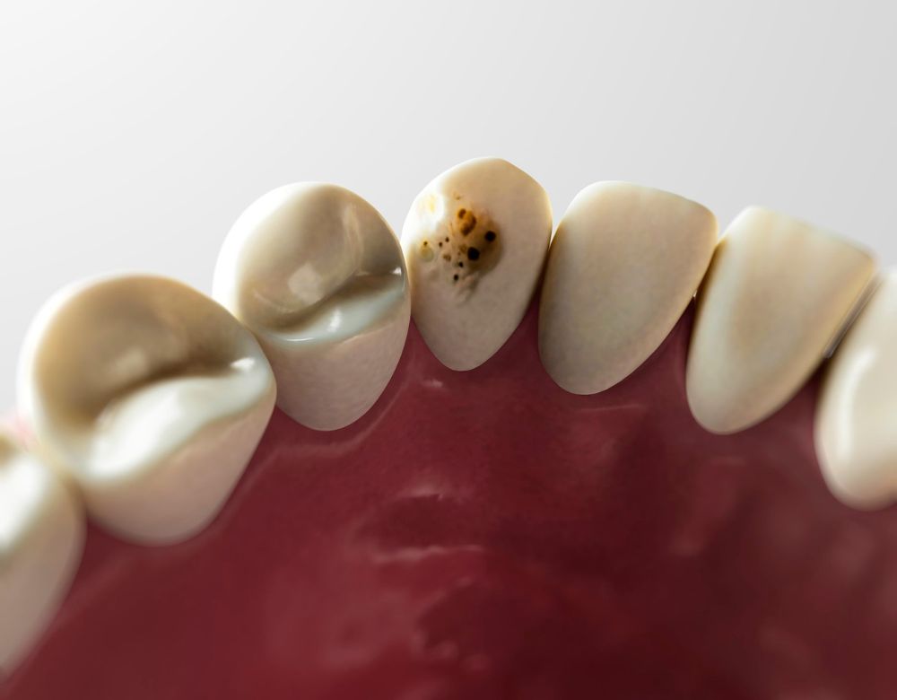 COSMETIC TOOTH BONDING 1