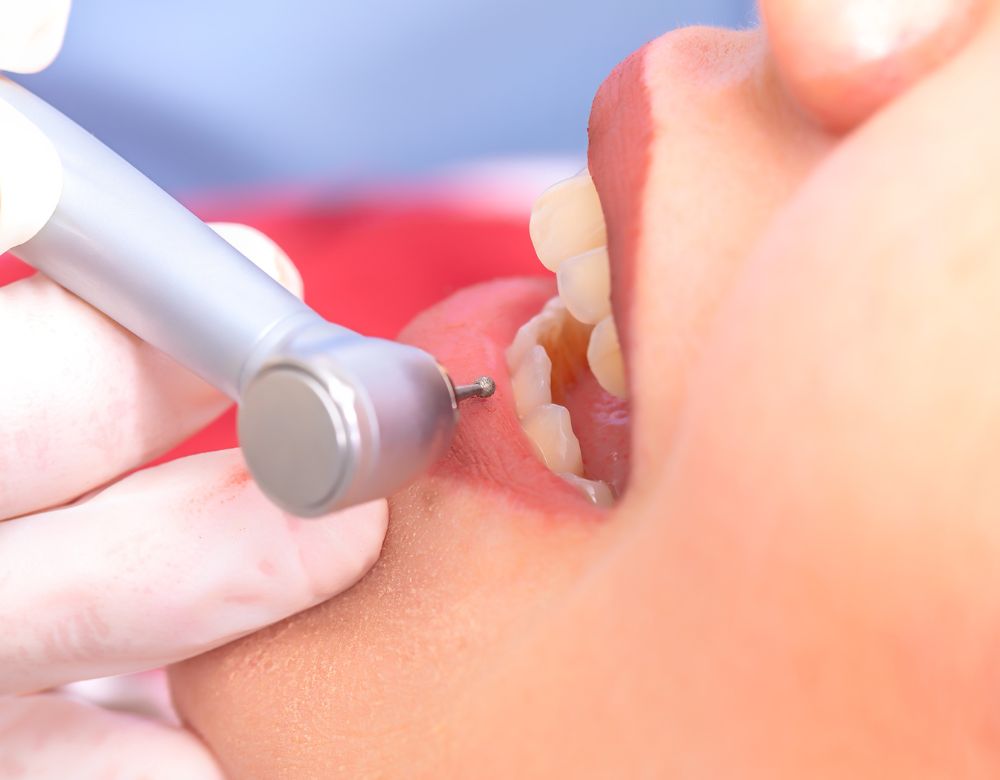 Teeth Cleaning Services in Calgary NE